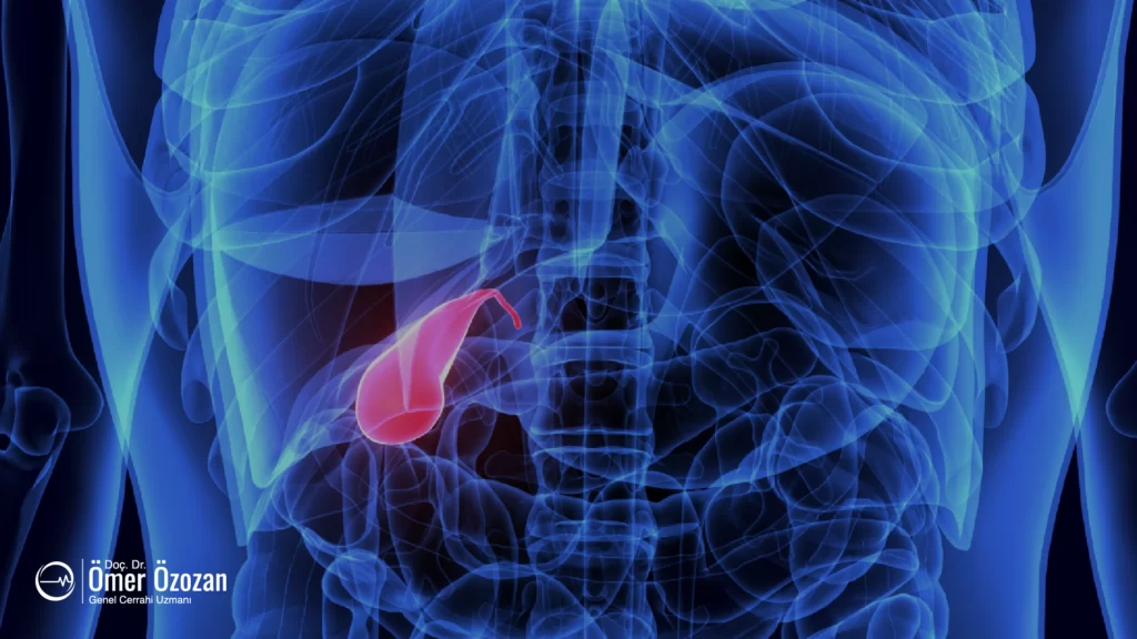 Safra Kesesi Polipleri