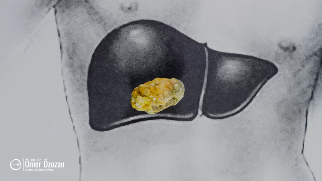 Safra Kesesi Taşları